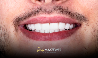 Zoom whitening at smile makeover