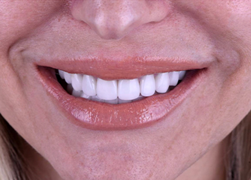 complete mouth veneers in smile makeover