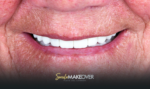 all on 4 dental treatment at smile makeover in playa del carmen