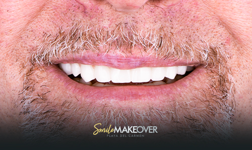 Full smile makeover in mexico