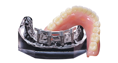 Snap on dentures with regular implants