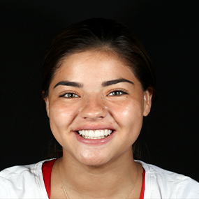 young woman  smiling after full mouth dental makeover in cancun mexico